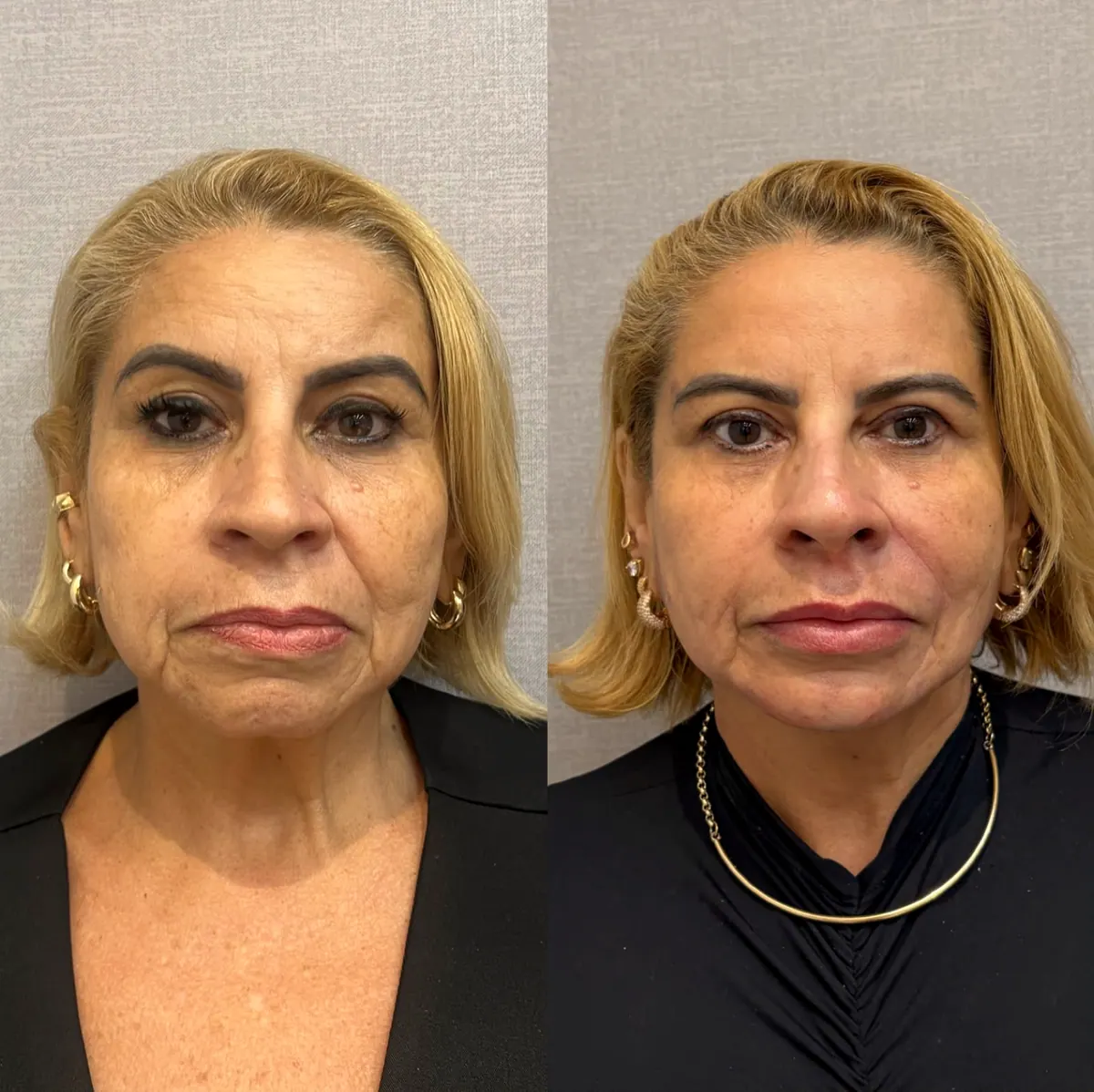 Fotos de full face lado a lado, com o rosto da paciente de frente
