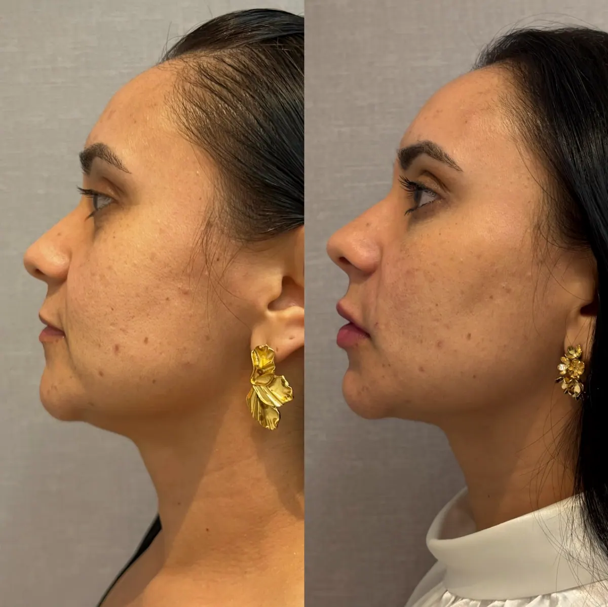 Fotos de full face lado a lado, com o perfil e a linha da mandíbula