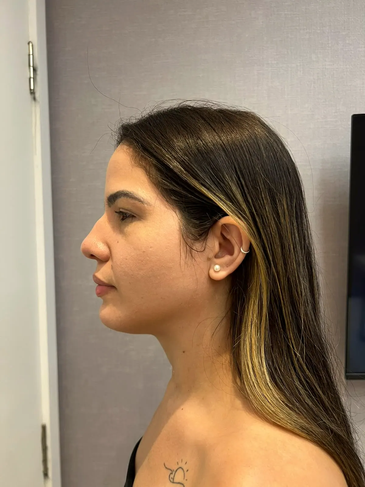 Perfil da mesma paciente, com o contorno do queixo mais definido